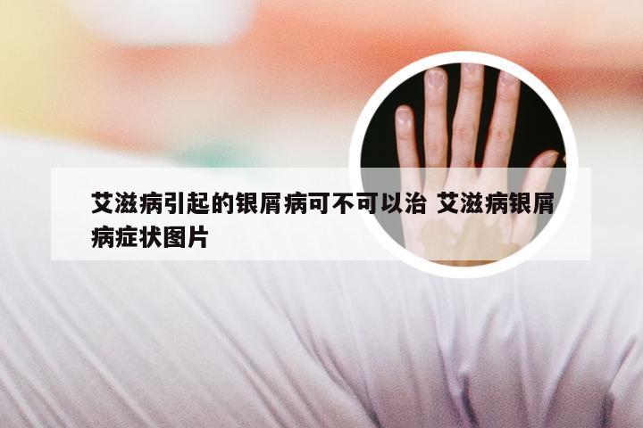 艾滋病引起的银屑病可不可以治 艾滋病银屑病症状图片