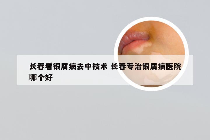 长春看银屑病去中技术 长春专治银屑病医院哪个好