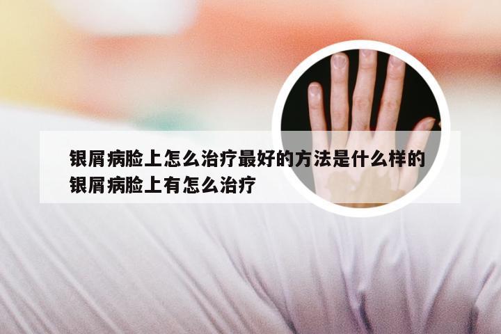 银屑病脸上怎么治疗最好的方法是什么样的 银屑病脸上有怎么治疗