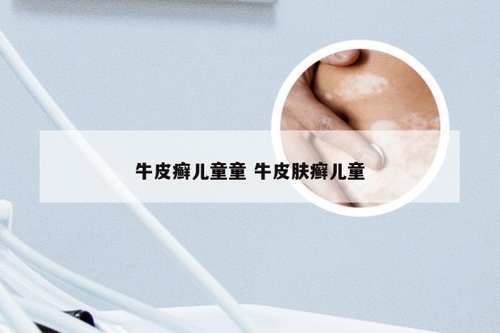 牛皮癣儿童童 牛皮肤癣儿童