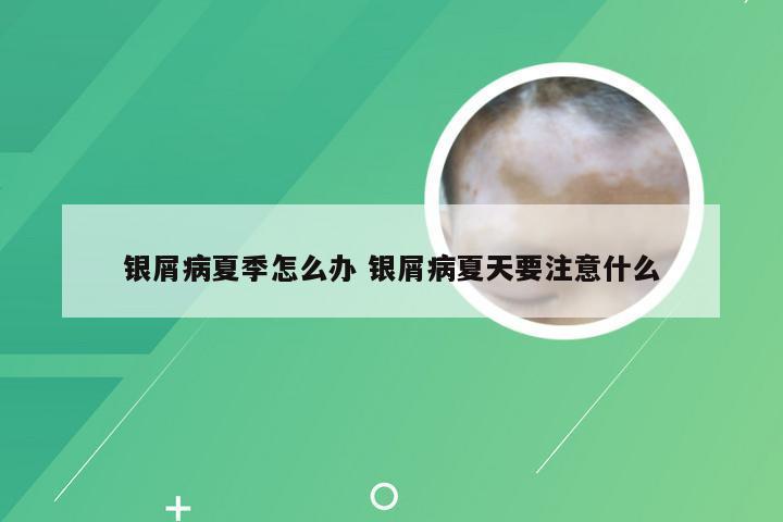 银屑病夏季怎么办 银屑病夏天要注意什么
