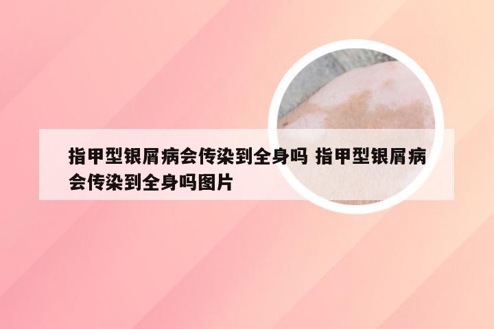 指甲型银屑病会传染到全身吗 指甲型银屑病会传染到全身吗图片