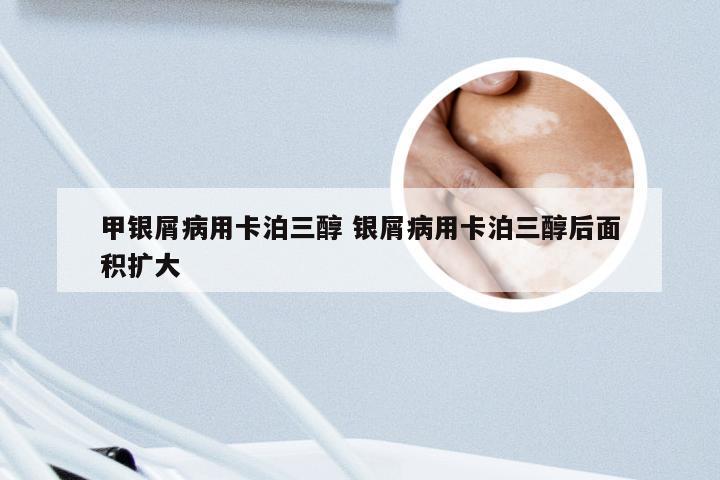 甲银屑病用卡泊三醇 银屑病用卡泊三醇后面积扩大