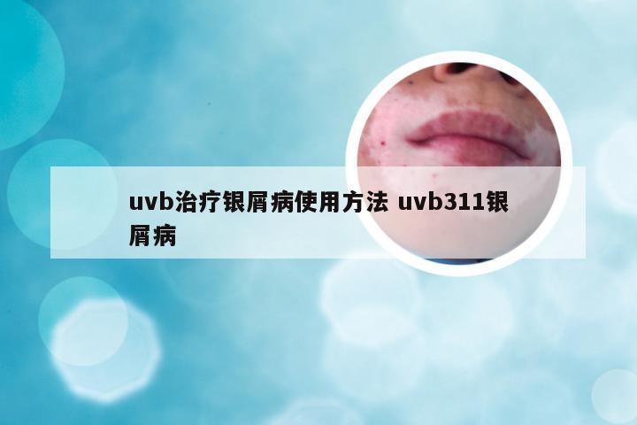 uvb治疗银屑病使用方法 uvb311银屑病
