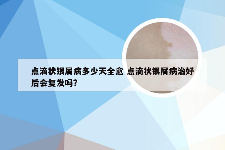 点滴状银屑病多少天全愈 点滴状银屑病治好后会复发吗?