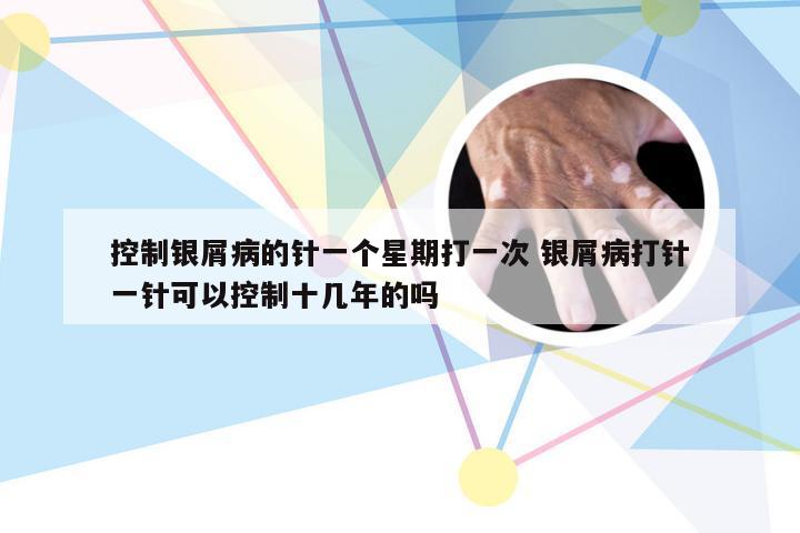控制银屑病的针一个星期打一次 银屑病打针一针可以控制十几年的吗