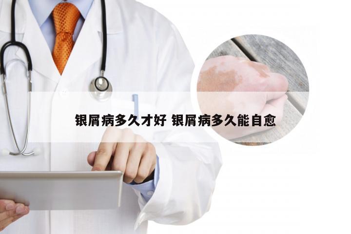 银屑病多久才好 银屑病多久能自愈
