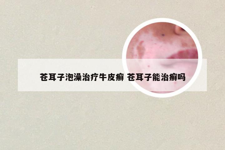 苍耳子泡澡治疗牛皮癣 苍耳子能治癣吗