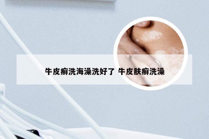 牛皮癣洗海澡洗好了 牛皮肤癣洗澡