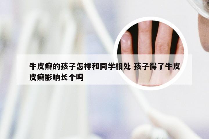 牛皮癣的孩子怎样和同学相处 孩子得了牛皮皮癣影响长个吗