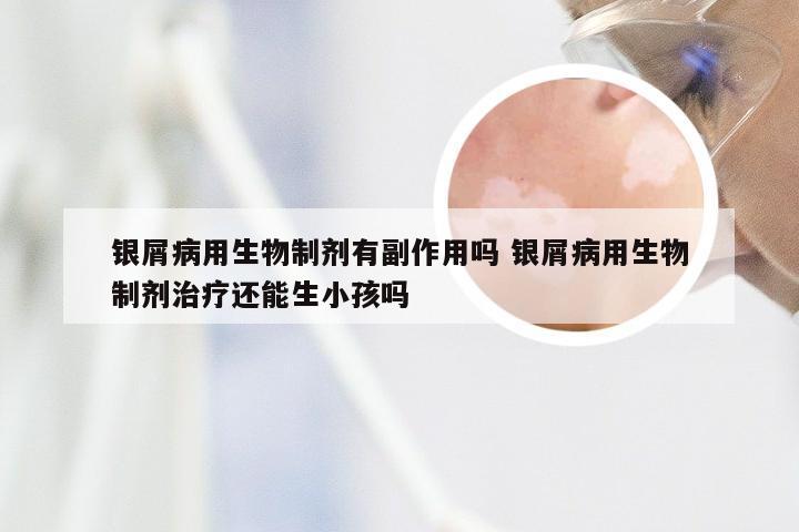 银屑病用生物制剂有副作用吗 银屑病用生物制剂治疗还能生小孩吗