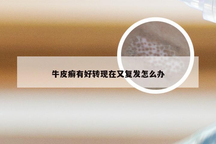 牛皮癣有好转现在又复发怎么办