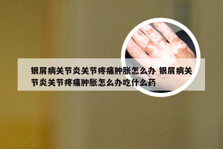 银屑病关节炎关节疼痛肿胀怎么办 银屑病关节炎关节疼痛肿胀怎么办吃什么药