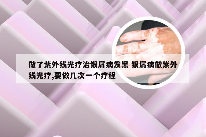 做了紫外线光疗治银屑病发黑 银屑病做紫外线光疗,要做几次一个疗程