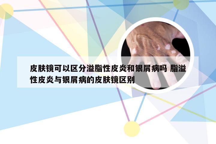 皮肤镜可以区分溢脂性皮炎和银屑病吗 脂溢性皮炎与银屑病的皮肤镜区别