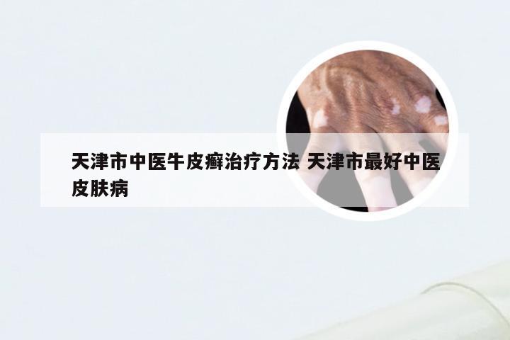 天津市中医牛皮癣治疗方法 天津市最好中医皮肤病