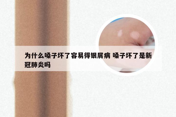 为什么嗓子坏了容易得银屑病 嗓子坏了是新冠肺炎吗