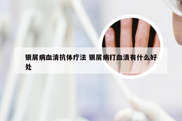 银屑病血清抗体疗法 银屑病打血清有什么好处