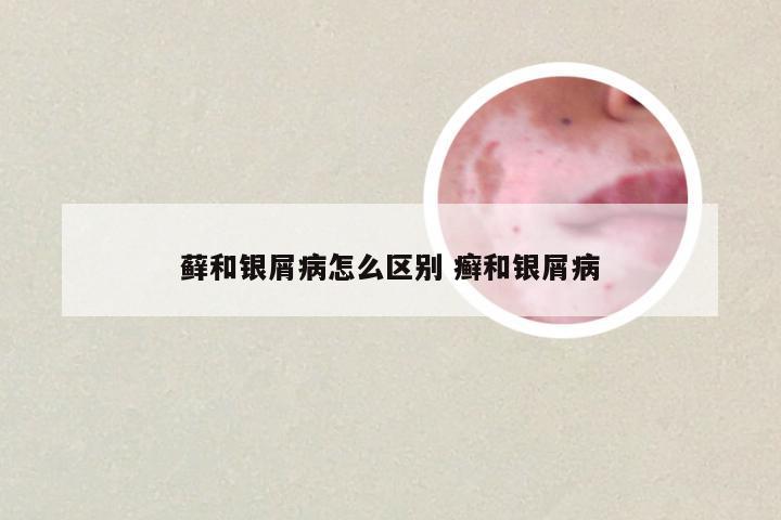 藓和银屑病怎么区别 癣和银屑病