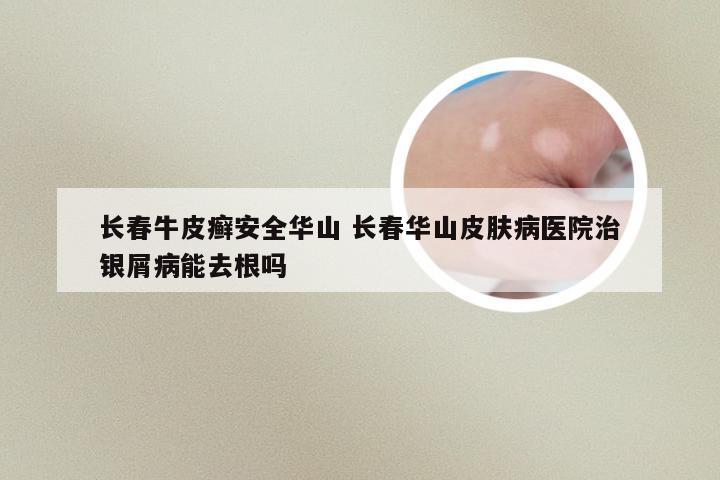 长春牛皮癣安全华山 长春华山皮肤病医院治银屑病能去根吗
