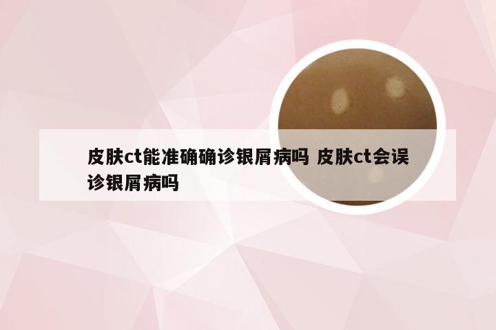 皮肤ct能准确确诊银屑病吗 皮肤ct会误诊银屑病吗