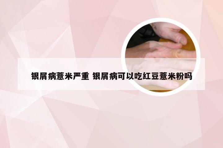 银屑病薏米严重 银屑病可以吃红豆薏米粉吗