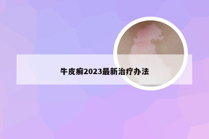 牛皮癣2023最新治疗办法