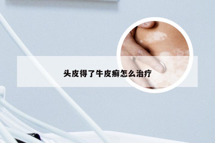 头皮得了牛皮癣怎么治疗