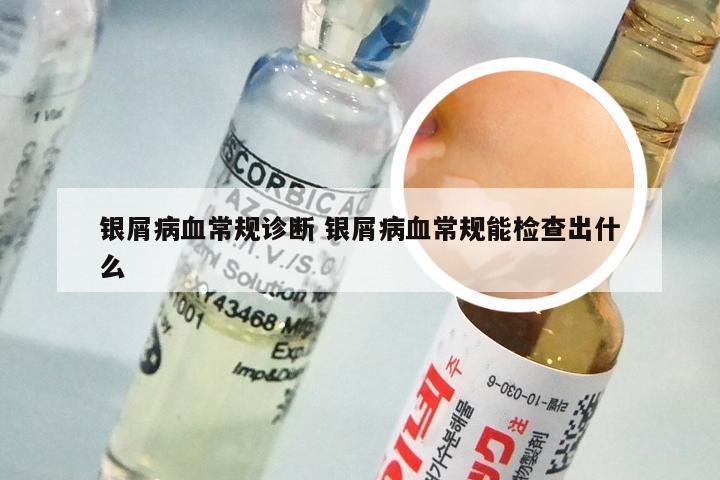 银屑病血常规诊断 银屑病血常规能检查出什么