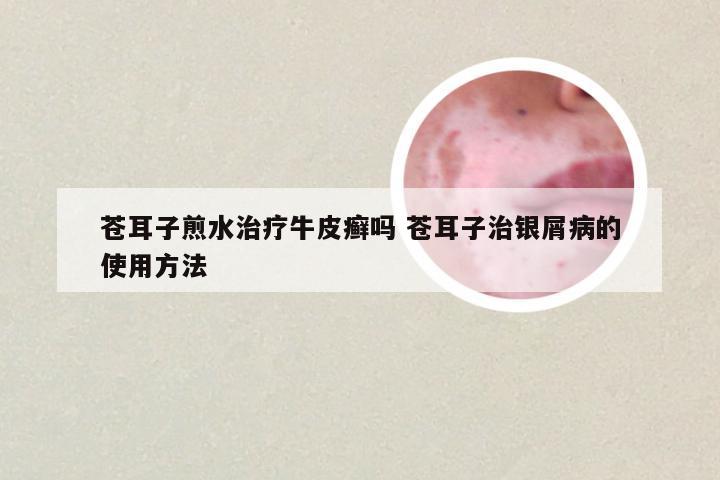 苍耳子煎水治疗牛皮癣吗 苍耳子治银屑病的使用方法