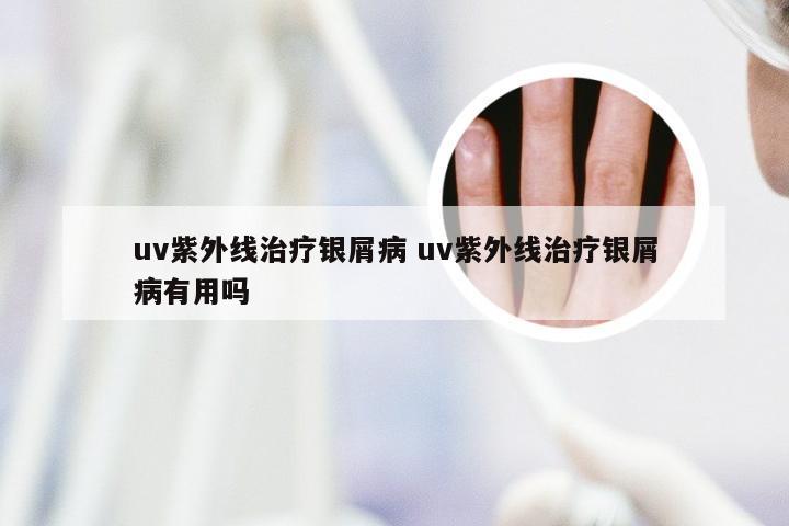 uv紫外线治疗银屑病 uv紫外线治疗银屑病有用吗