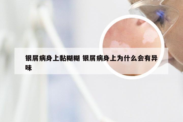 银屑病身上黏糊糊 银屑病身上为什么会有异味