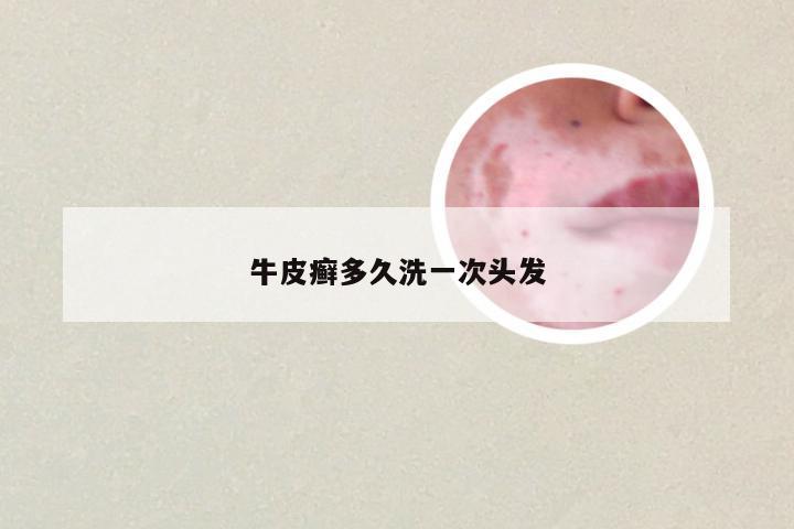 牛皮癣多久洗一次头发