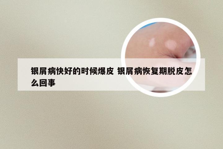 银屑病快好的时候爆皮 银屑病恢复期脱皮怎么回事