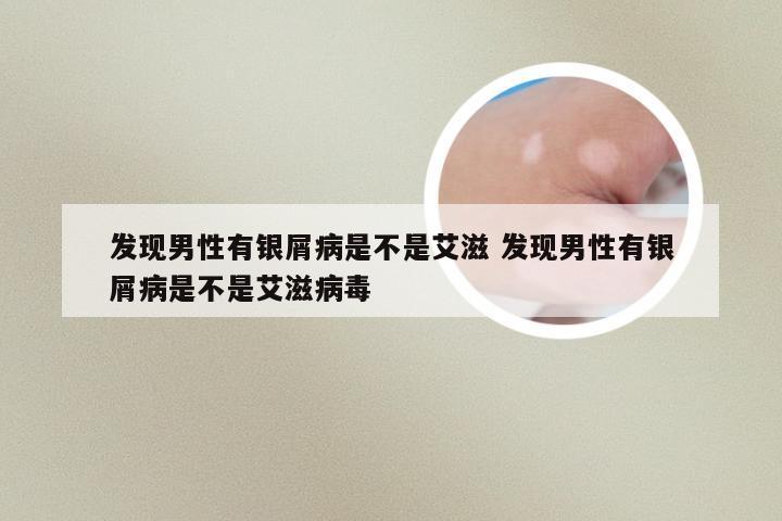 发现男性有银屑病是不是艾滋 发现男性有银屑病是不是艾滋病毒