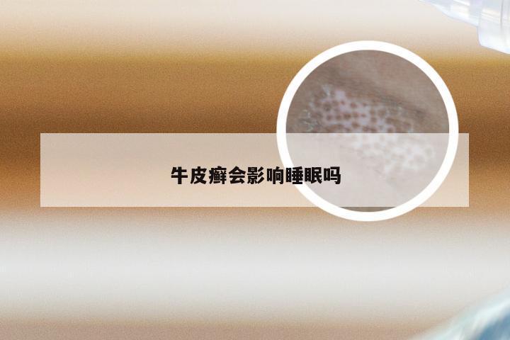 牛皮癣会影响睡眠吗