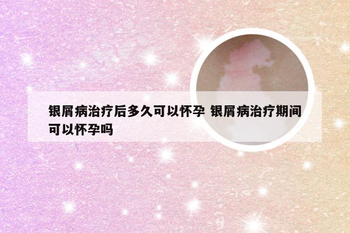 银屑病治疗后多久可以怀孕 银屑病治疗期间可以怀孕吗