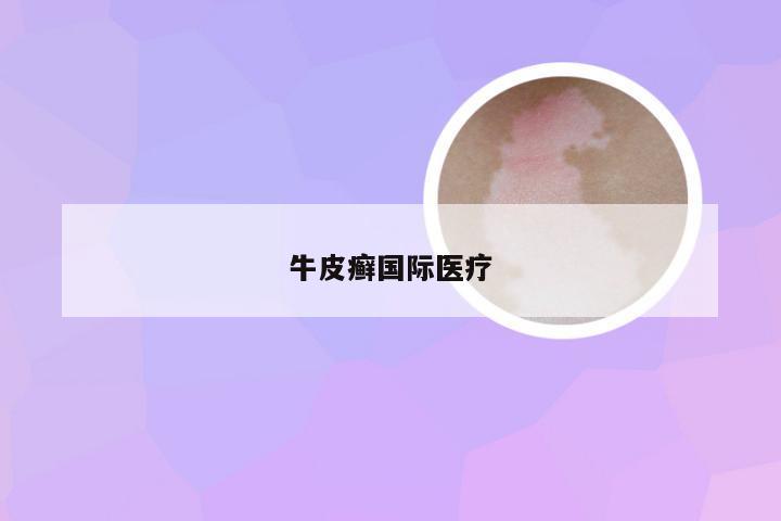 牛皮癣国际医疗