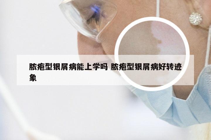 脓疱型银屑病能上学吗 脓疱型银屑病好转迹象