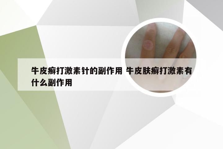 牛皮癣打激素针的副作用 牛皮肤癣打激素有什么副作用