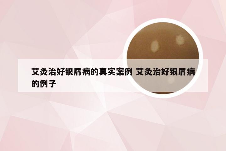 艾灸治好银屑病的真实案例 艾灸治好银屑病的例子