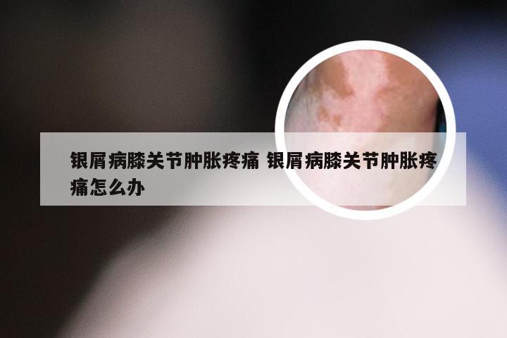 银屑病膝关节肿胀疼痛 银屑病膝关节肿胀疼痛怎么办