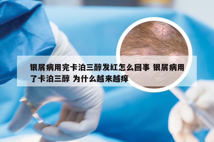 银屑病用完卡泊三醇发红怎么回事 银屑病用了卡泊三醇 为什么越来越痒