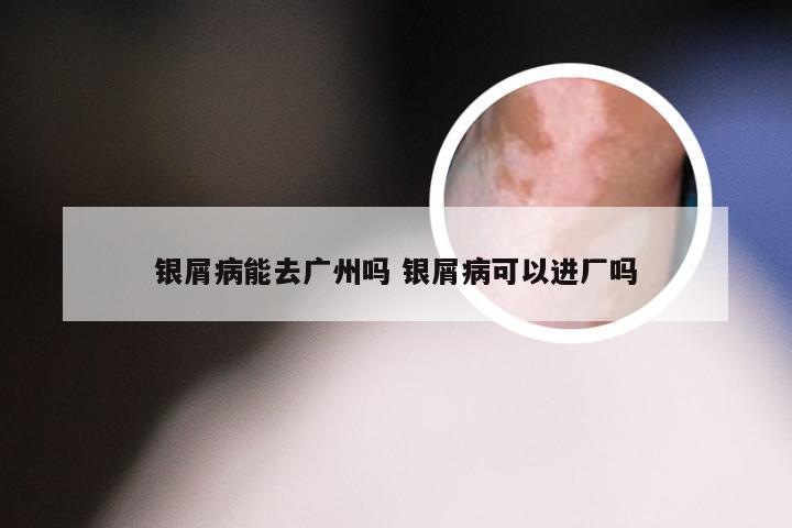 银屑病能去广州吗 银屑病可以进厂吗