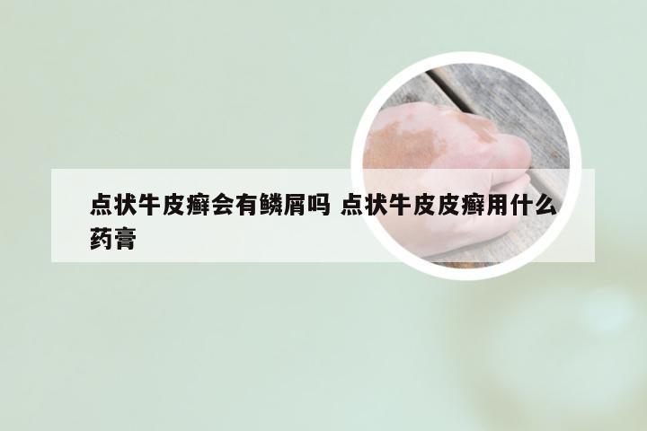 点状牛皮癣会有鳞屑吗 点状牛皮皮癣用什么药膏