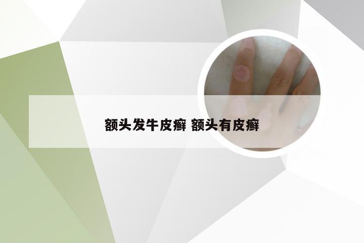 额头发牛皮癣 额头有皮癣