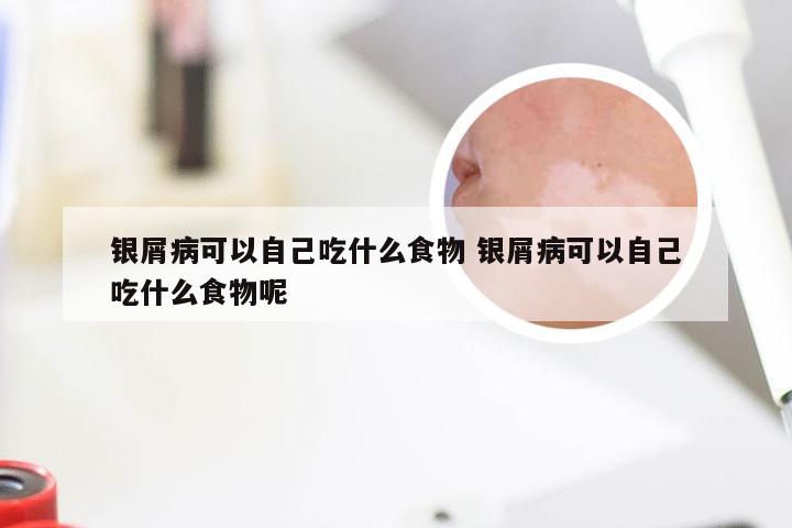 银屑病可以自己吃什么食物 银屑病可以自己吃什么食物呢