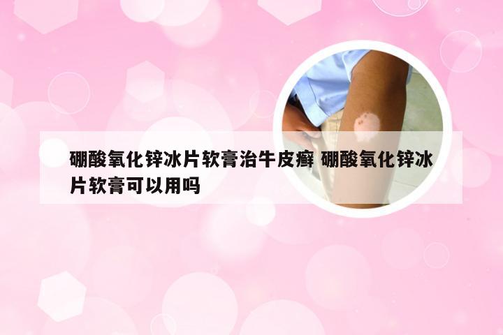 硼酸氧化锌冰片软膏治牛皮癣 硼酸氧化锌冰片软膏可以用吗