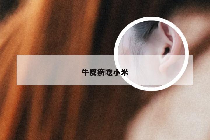 牛皮癣吃小米