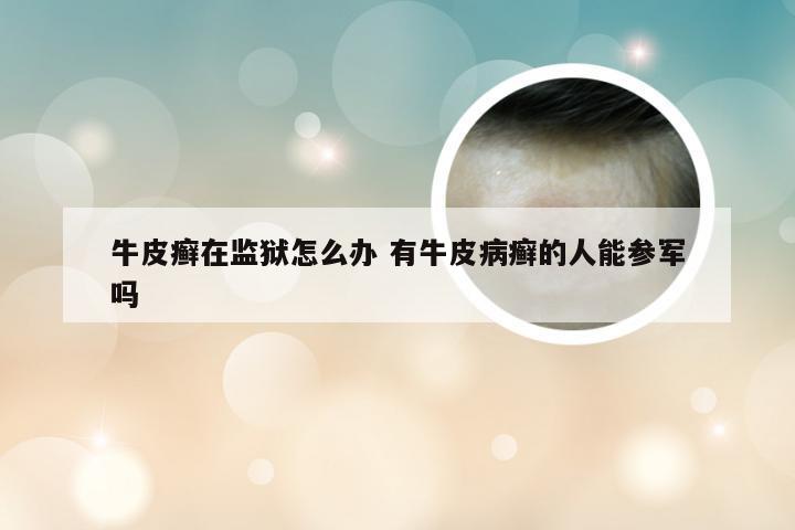 牛皮癣在监狱怎么办 有牛皮病癣的人能参军吗